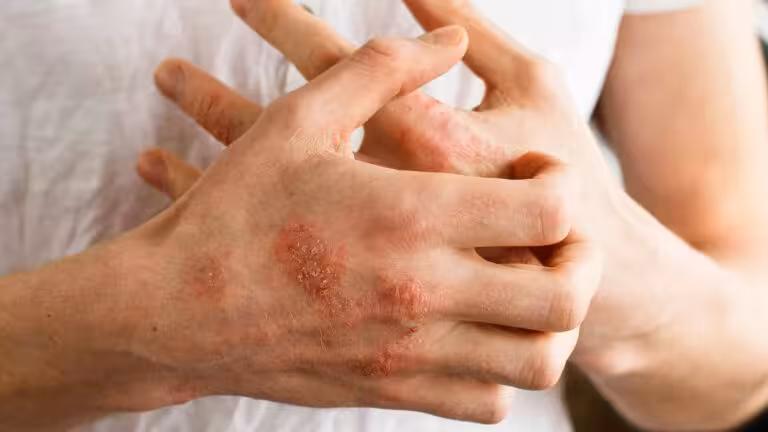 psoriasis-768x432